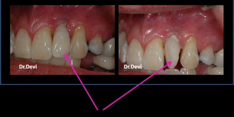 Dental Implants Problems