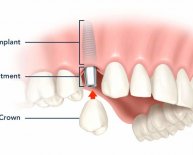 Are dental implants covered by dental insurance