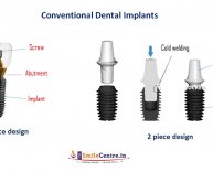 Side effects of Dental Implants