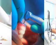Types of implants in Dentistry