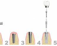 What is Dental Implants procedure?